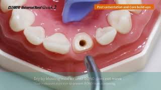 How to with UBQ 2 Post Cementation and Core Build Up [upl. by Artima]