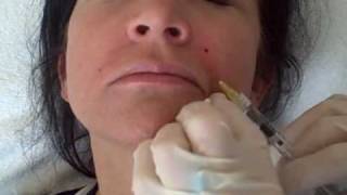 Restylane treatment for lines and wrinkles with Tracey Bell [upl. by Aihpled155]