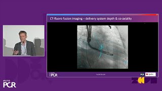 Transformative imaging in the clinical pathway of transcatheter tricuspid valve interventions [upl. by Adnolor857]