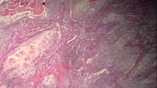 Bronchogenic carcinoma عملي عبد الرحمن خليفة [upl. by Verena625]