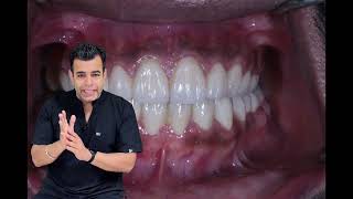 Pathological tooth migration मेरे सामने के दांत धीरेधीरे फैल गए हैं  Drifting of Teeth [upl. by Ailliw8]