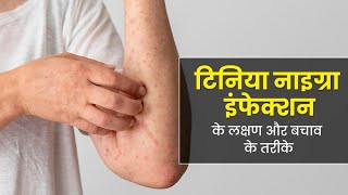 What is Tinea Nigra Fungal Infection  गर्मियों में बढ़ जाता है टिनिया नाइग्रा इंफेक्शन का जोखिम [upl. by Anatollo]