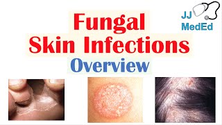 Overview of Fungal Skin Infections  Tinea Infections [upl. by Anerak]