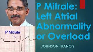 P Mitrale – Left Atrial Abnormality or Overload [upl. by Eelarat592]