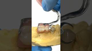 Adding a Crown for a Metal Clasped Partial lsk121shorts dentistry teeth [upl. by Erle]