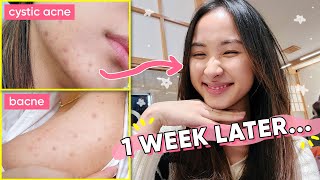 1 THING that healed amp reset my hormonal acne NATURALLY  Acne Series [upl. by Hamann203]