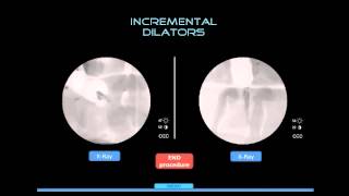 Spinal Fixation Simulation  ExRayLab [upl. by Choo]