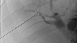 Percutaneous Biliary access under Fluoroscopy [upl. by Alywt]