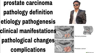 prostate carcinoma  prostate cancer  pathology notes  definitionetiologypathogenesishindi [upl. by Louanne]