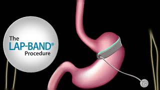 Fast Facts about The LAPBAND® procedure [upl. by Niroht]