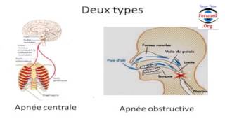 Faites Vous des Apnées de Sommeil [upl. by Nairrod]