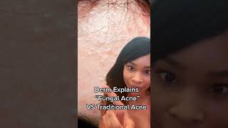 Why those tiny bumps arent Fungal Acne [upl. by Virgil]