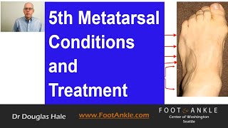 5th Metatarsal Conditions  Seattle Podiatrist [upl. by Seuguh]