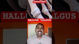 HALLUX VALGUS procedure [upl. by Marshall]