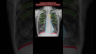 Radiografía de Tórax PA TEST  Díagnosticos Radiológicos radiografía anatomía medicina shorts [upl. by Leboff]