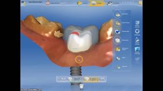 Coroane dentare si bont protetic realizate digital intro singura sedinta cu Cerec CadCam [upl. by Jer]