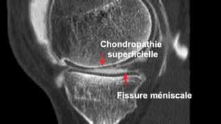 Chondropathie fémorotibiale et Arthroscanner [upl. by Biamonte246]