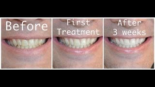 Howto Whiten your teeth with Hydrogen Peroxide [upl. by Simpson]