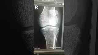 X ray Rt knee ap lat music halloween [upl. by Aldred190]