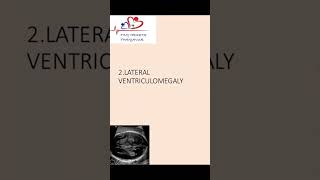 Lateral ventriculomegaly of fetal brain on antenatal scan ventriculomegaly [upl. by Carline]