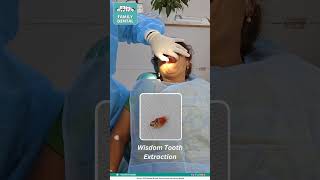 Wisdom Tooth Removal 🦷FamilyDentalMoulali [upl. by Xenia]