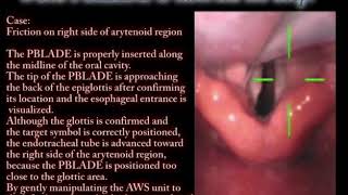 Video Laryngoscope Airway scopeAWS  Case friction on right side of arytenoid region [upl. by Kinemod256]