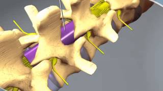 What to expect during an Epidural Steroid Injection at RAYUS [upl. by Puto]