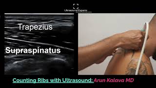 Counting Ribs On Ultrasound [upl. by Aleyam]