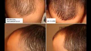 Tratament Păr  Scapă de chelie calviție alopecie Kirkland Minoxidil 5wmv [upl. by Noiraa872]