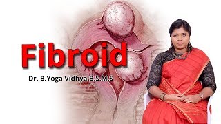 ஃபைப்ராய்டு கட்டிகளுக்கு சிகிச்சை  Fibroid Uterus Treatment  Dr BYoga Vidhya [upl. by Seadon]