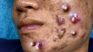 Big Cystic Acne Blackheads Extraction Blackheads amp Milia Whiteheads Removal Pimple Popping 095 [upl. by Quintin]