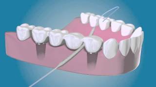 Bridge And Implant Floss by TePe [upl. by Ecylla]