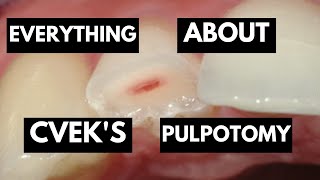 Master Your Concepts for Cveks Pulpotomy  Everything You Need To Know [upl. by Yerrot]