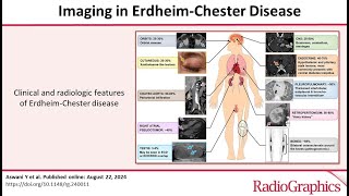 Imaging in ErdheimChester Disease dr Sara NASR [upl. by Sudhir]