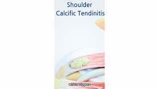 Unveiling The Stages Of Calcific Tendinitis Symptoms [upl. by Drawd]