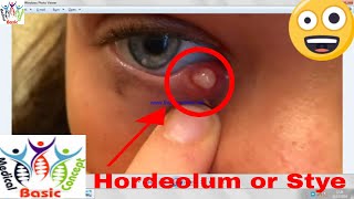 Hordeolum externum OR Stye on Eyelid amp Hordeolum internum with Treatment  EyeOphthalmology [upl. by Gittel133]