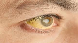 What Causes Bulging Eyes In Graves Disease [upl. by Aufmann]