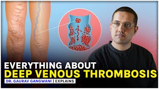 Deep Venous Thrombosis  DVT  IVC filter  Dr Gaurav Gangwani [upl. by Claretta]