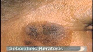 Common Skin Lesions [upl. by Niret]