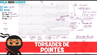 Rate and Rhythm  Torsades de Pointes [upl. by Brenn]