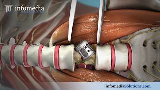 Lumbar Discectomy and Fusion [upl. by Gitt]