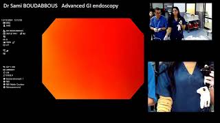 balloon dilatation for achalasia [upl. by Chelton]