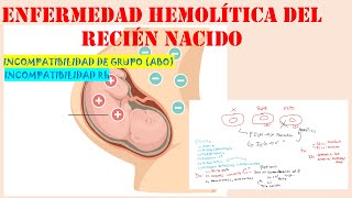 ENFERMEDAD HEMOLÍTICA DEL RECIÉN NACIDO INCOMPATIBILIDAD DE GRUPO  INCOMPATIBILIDAD RH [upl. by Ikoek321]