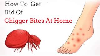 how to get rid of chigger bites [upl. by Nilecoj776]