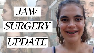 Adult Braces amp Double Jaw Surgery 5 Months Post Op [upl. by Eirene]