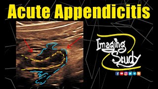 Acute Appendicitis  Ultrasound  Case 292 [upl. by Lladnew]