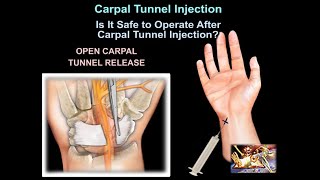 Carpal Tunnel Injection  Everything You Need To Know  Dr Nabil Ebraheim [upl. by Annayi]