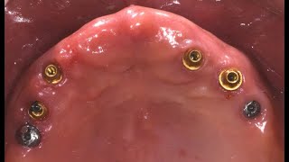 Full mouth rehabilitation using Screw AbutmentProfJanghyun Paek [upl. by Carolan312]