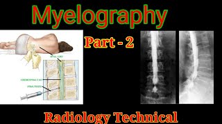 Myelography procedure  Part  2  Myelogram examination  By BL Kumawat [upl. by Piwowar]