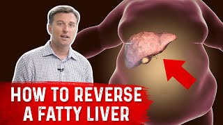 How to Reverse a Fatty Liver  Dr Berg [upl. by Claire]